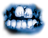Bahan-bahan yang beracun dalam met menyebabkan kerusakan  gigi yang parah, dikenal sebagai 